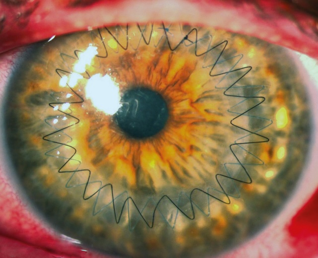 Vue post-opératoire d’une kératoplastie transfixiante avec double suture en surjet, greffon centré, jonction nette et absence de réaction inflammatoire.