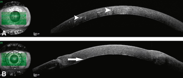 OCT montrant des opacités stromales profondes avant greffe, puis une kératoplastie lamellaire avec interface visible entre greffon et couche descemétique.