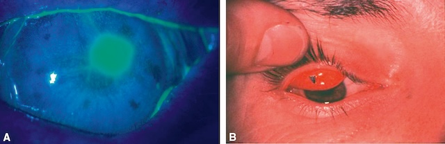 Vue en fluorescéine d’une large érosion cornéenne centrale, avec inspection du cul-de-sac inférieur à la recherche d’un corps étranger mécanique.