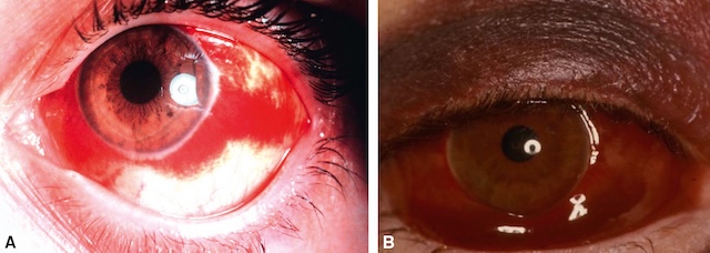 Hémorragies sous-conjonctivales : bénigne étendue en A, suspecte en B par hématome inférieur pouvant dissimuler une plaie sclérale.