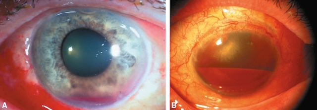 Medium,Hyphéma modéré avec lame sanguine déclive (A) et hyphéma massif occupant la moitié de la chambre antérieure avec sédimentation nette (B).