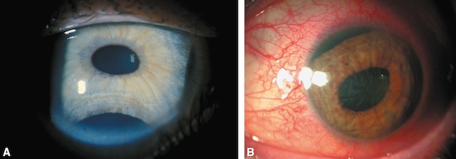 Iridodialyses traumatiques visibles en inférieur (A) et supérieur (B), avec double pupille ou déformation irienne postérieure à un arrachement partiel.