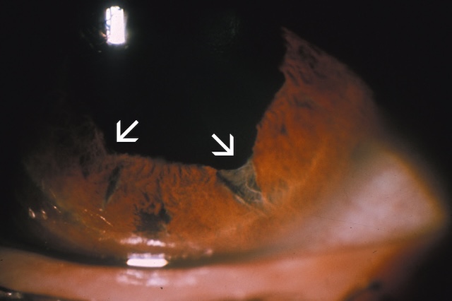 Deux ruptures nettes du sphincter irien en inférieur, traduisant une atteinte post-traumatique de la pupille avec perte localisée de la continuité musculaire.
