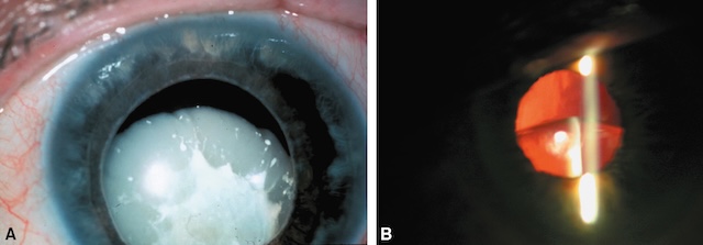 Cristallin opacifié et partiellement luxé, visible en lumière directe et à la lampe à fente, empêchant la vision normale du fond d’œil.