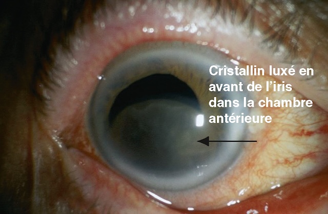 Cristallin luxé dans la chambre antérieure, refoulant l’iris en arrière, opaque, en contact avec la cornée, risquant une hypertonie aiguë.