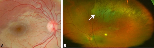 Œdèmes rétiniens post-traumatiques au pôle postérieur (A) et en périphérie supérieure (B), sans hémorragie ni décollement associé.