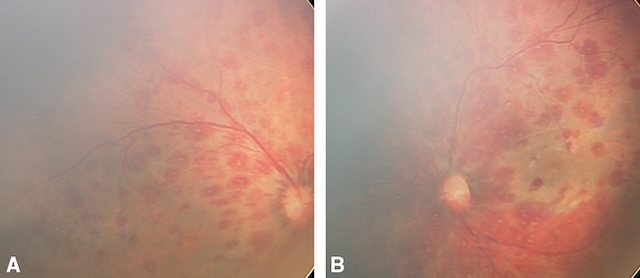 Hémorragies rétiniennes bilatérales étagées et diffuses, typiques d’un traumatisme non accidentel comme dans un syndrome du bébé secoué.