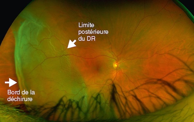 Décollement rétinien traumatique étendu avec déchirure géante périphérique, limite ondulée bien visible et pôle postérieur encore appliqué.