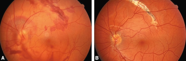 Ruptures choroïdiennes traumatiques : aiguë masquée par des hémorragies en A, et cicatricielle bien visible en bande blanchâtre en B.