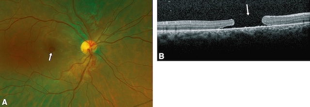 Medium,Trou maculaire post-traumatique visible au fond d’œil et confirmé en OCT par une rupture pleine épaisseur des couches rétiniennes au centre de la macula.