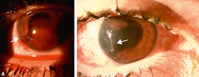 Plaie cornéenne traumatique avec protrusion irienne (A), suivie d’une cicatrice blanchâtre bien centrée avec déformation pupillaire résiduelle (B).
