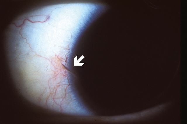 Petite plaie cornéosclérale localisée avec congestion vasculaire périphérique, sans protrusion ni réaction intraoculaire visible.