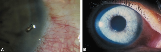 Medium,Corps étranger cornéen superficiel en A avec hyperhémie localisée ; opacités cicatricielles cornéennes visibles sous transillumination annulaire en B.