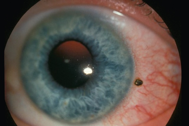 Corps étranger superficiel bien visible sur la conjonctive bulbaire temporale, avec réaction inflammatoire localisée et cornée intacte.