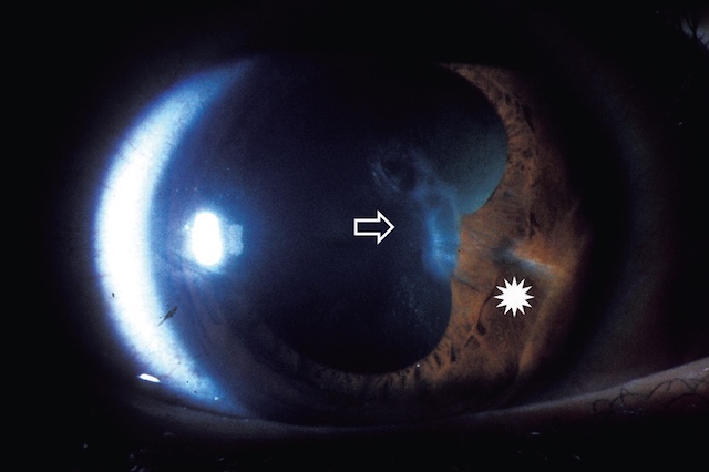 Medium,Brèches traumatiques de l’iris et du cristallin évoquant un trajet perforant typique d’un corps étranger intraoculaire avec point d’entrée et d’impact.