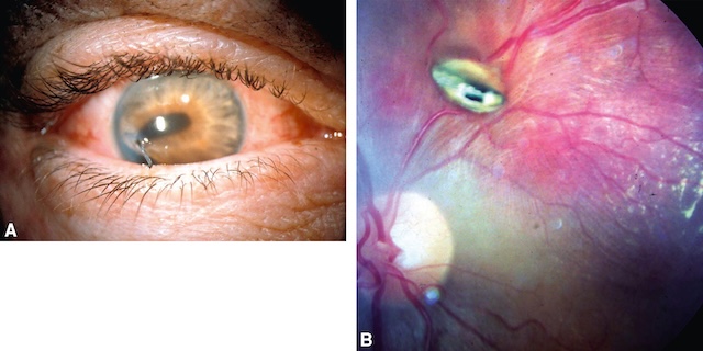 Corps étranger intraoculaire visible dans l’iris en antérieur et enchâssé dans la rétine en postérieur, traduisant un traumatisme perforant complexe.