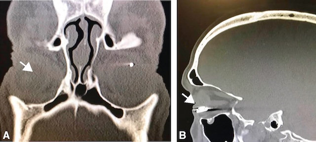Corps étranger métallique bien visible en scanner, localisé en arrière du globe dans l’orbite droite, sans fracture osseuse ni migration apparente.