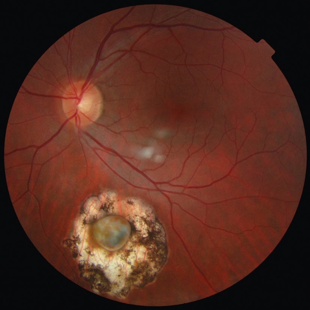 Corps étranger intraoculaire ancien encapsulé avec sidérose débutante, visible par pigmentation périphérique et altération rétinienne progressive.