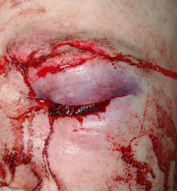 Plaie palpébrale supérieure avec hématome et saignement diffus, œdème masquant l’œil, évoquant un traumatisme contus grave à explorer rapidement.