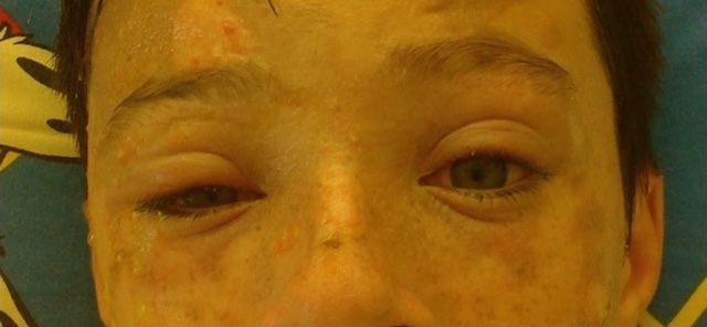 Brûlure faciale par flamme avec œdème palpébral asymétrique et lésions cutanées croûteuses, évocatrices d’un second degré nécessitant soins oculaires urgents.