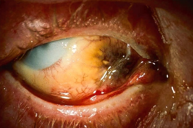 Brûlure acide grave avec cornée blanchâtre, nécrose conjonctivale noire et ischémie sclérale, traduisant une atteinte oculaire profonde irréversible.