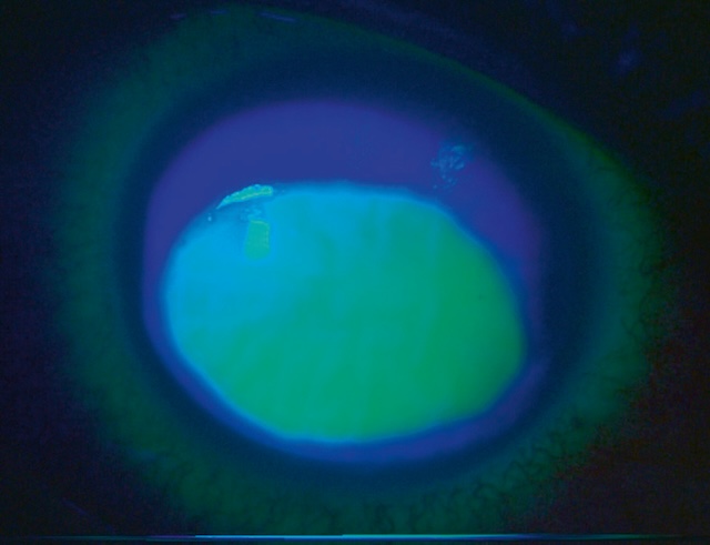 Large décollement épithélial cornéen central à la fluorescéine, typique d’une brûlure caustique aiguë par base forte de type soude ménagère.