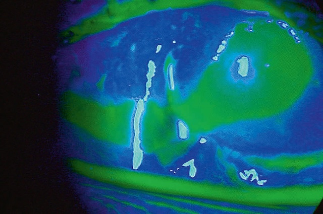 Perte épithéliale cornéenne étendue et fluorescéine diffuse, signe d’une brûlure sévère par soude, avec atteinte profonde et risque de complications graves.