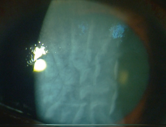 Plis endothéliaux marqués et œdème cornéen diffus liés à une brûlure sévère par soude, témoignant d’un endothélium gravement altéré.