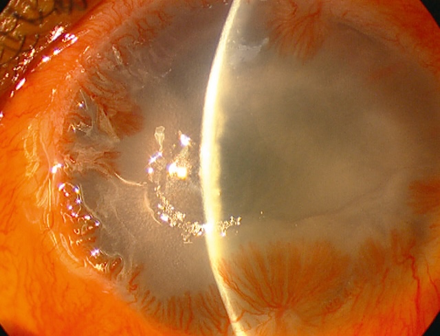 Cornée opaque et vascularisée témoignant d’une déficience limbiques totale après brûlure alcaline sévère, avec perte de transparence visuelle.