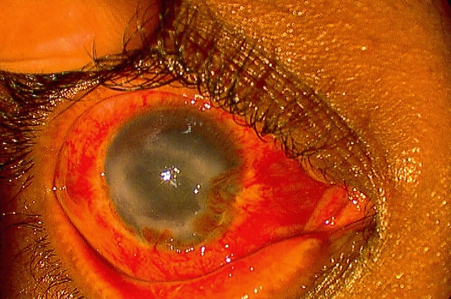 Cornée blanchâtre, vascularisée et opacifiée un mois après brûlure alcaline, traduisant une cicatrisation anormale et une atteinte limbique partielle.