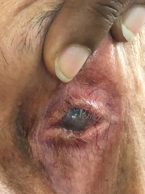 Œil avec cicatrices profondes palpébrales et opacification cornéenne complète, séquelles d’une brûlure ancienne par base forte.