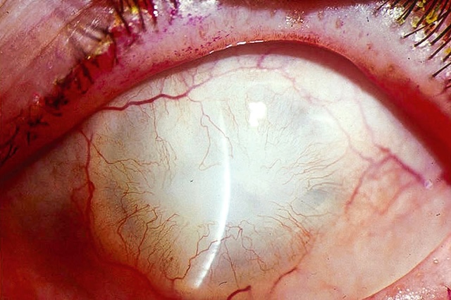 Cornée opaque et envahie de néovaisseaux, à 6 mois d’une brûlure par base forte, traduisant une atteinte sévère et chronique.