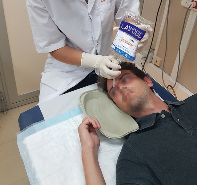 Lavage oculaire d’urgence avec irrigation abondante, geste crucial en cas d’exposition oculaire à un produit chimique.