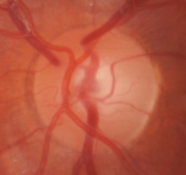 Papille optique à contours nets, physiologiquement excavée, sans anomalie visible.