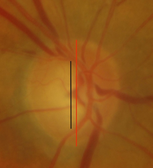 Excavation papillaire élargie avec rapport cup/disc augmenté, évocatrice de glaucome.