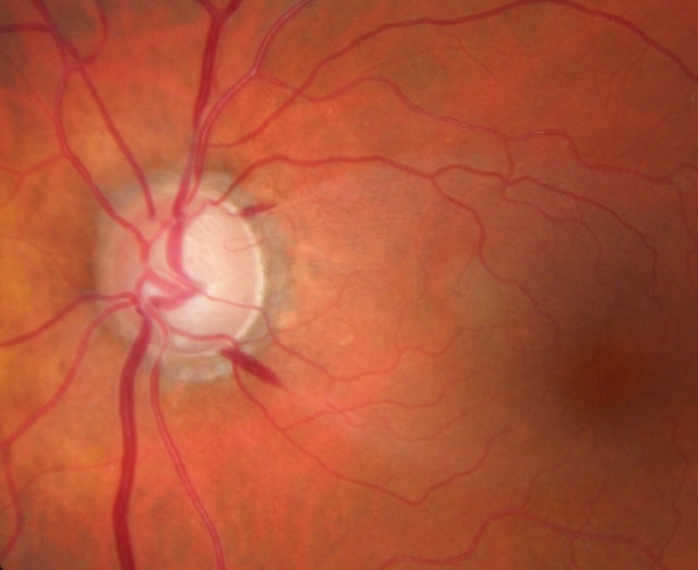 Hémorragie en flammèche et atrophie bêta, signes caractéristiques d’un glaucome.