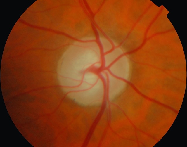 Excavation papillaire modérée avec rapport cup/disc augmenté sans anomalie marquée.