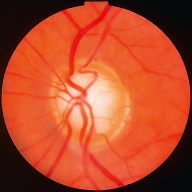 Aspect typique d’une excavation papillaire glaucomateuse évoluée avec atteinte sévère du bord neuro-rétinien.