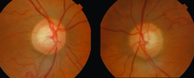 Excavation glaucomateuse asymétrique bilatérale dans un glaucome primitif à angle ouvert.