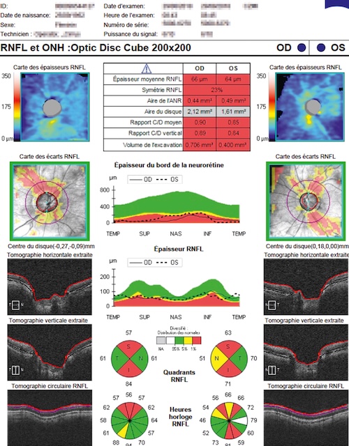 OCT montrant une atteinte glaucomateuse gauche avec amincissement RNFL et excavation augmentée.