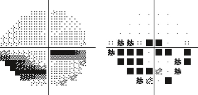 Scotome arciforme inférieur à l’œil droit sur périmétrie, typique d’un glaucome primitif à angle ouvert avec altération fonctionnelle localisée.