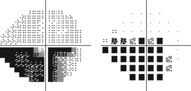 Élargissement du scotome inférieur et atteinte paracentrale témoignant d’une progression glaucomateuse marquée au fil du temps.