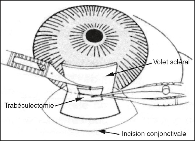 Incision conjonctivale et volet scléral permettent une dérivation contrôlée de l’humeur aqueuse dans le traitement du glaucome.