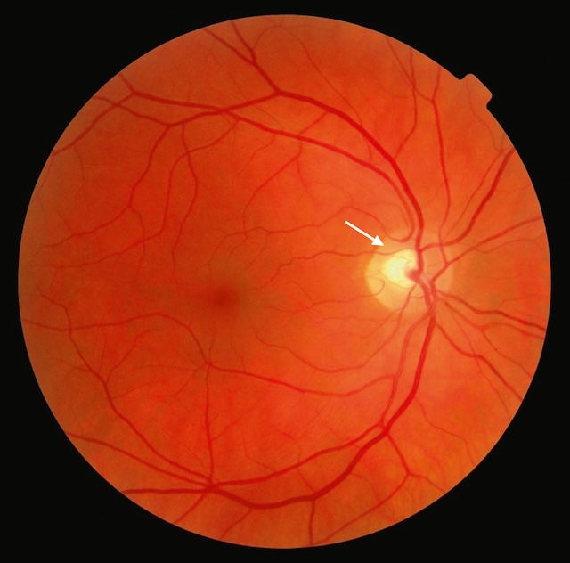 Papille optique bien définie avec reflet central discret, vascularisation normale et rétine d’apparence homogène sans anomalie visible.