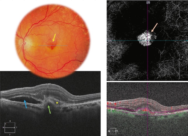 Présence d’une néovascularisation choroïdienne active avec soulèvement de l’EP, décollement séreux et matériel sous-rétinien sur DMLA exsudative.
