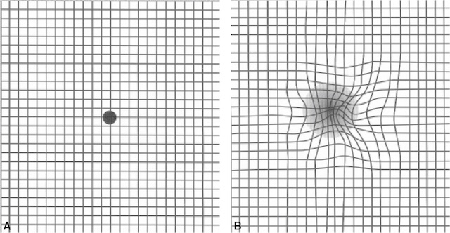 Altération du champ central visible à la grille d’Amsler, évoquant une pathologie maculaire type DMLA.
