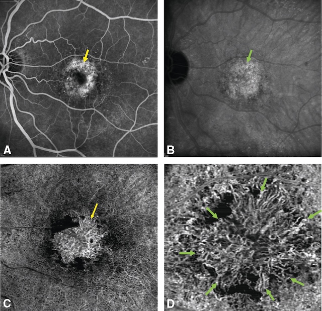 Imagerie multimodale illustrant une membrane néovasculaire choroïdienne avec hyperfluorescence et vascularisation anarchique.