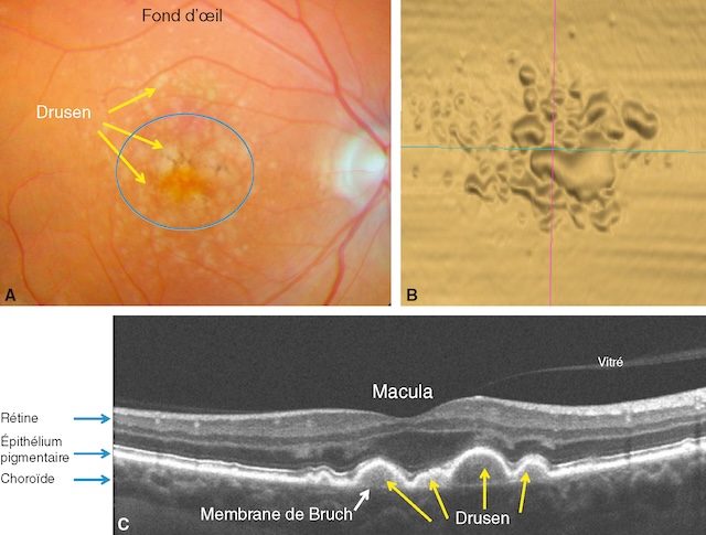 Images illustrant des drusen maculaires visibles au fond d’œil et en tomographie optique, signe de maculopathie liée à l’âge.