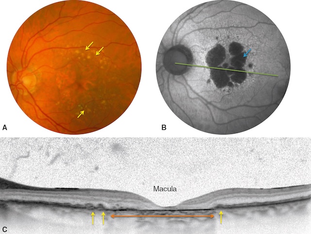 Forme atrophique de DMLA avec plages dépigmentées, perte de l’épithélium pigmentaire et atrophie maculaire centrale.