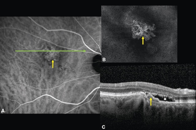 Medium,DMLA exsudative avec néovascularisation choroïdienne active visible en angiographie et en coupe OCT.